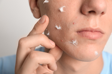 Photo of Teen guy with acne problem applying cream on light background, closeup