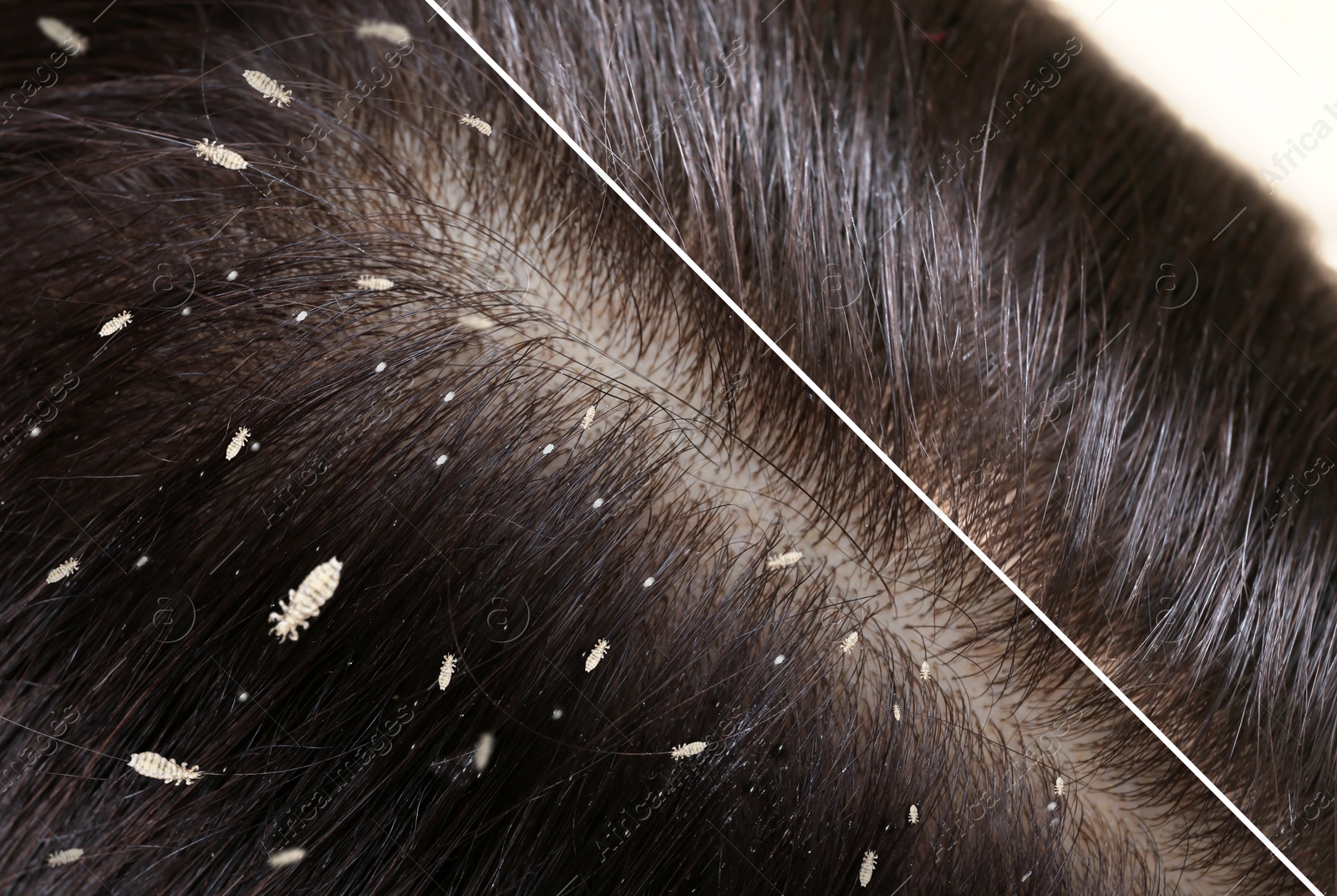 Image of Collage showing woman's hair before and after lice treatment, closeup. Suffering from pediculosis