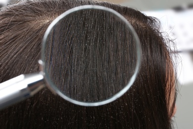 Photo of Closeup of woman with dandruff in her hair, view through magnifying glass