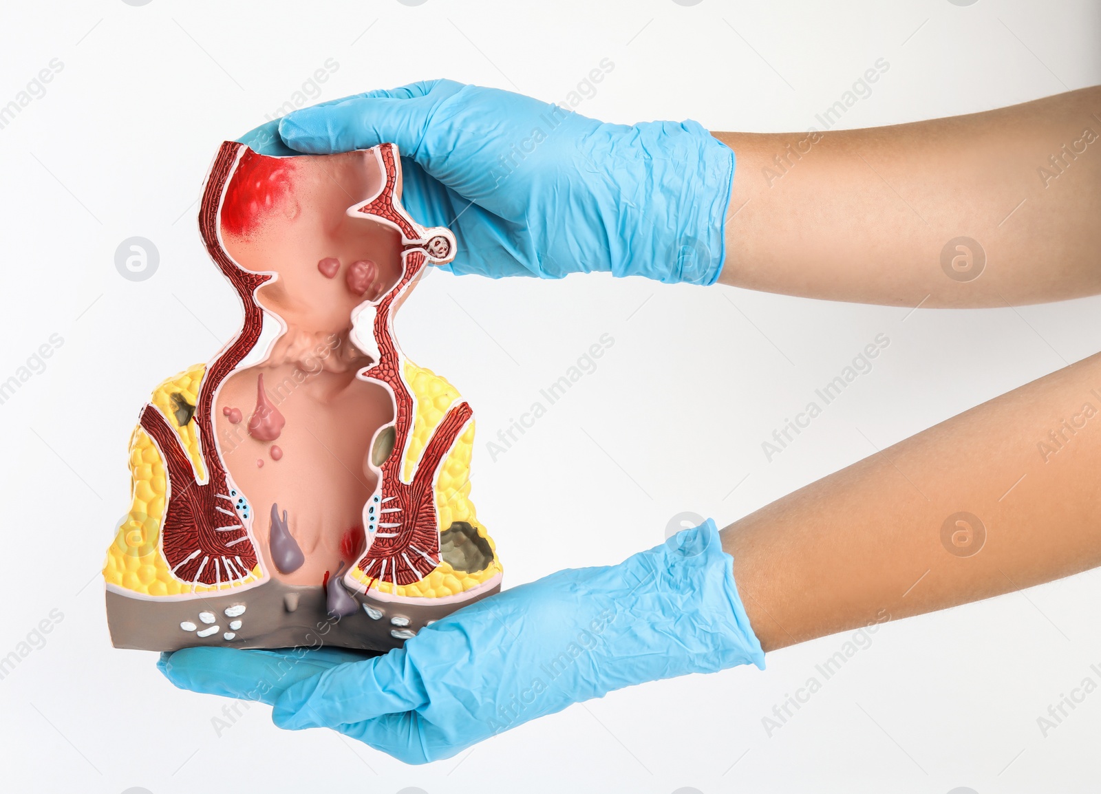 Photo of Proctologist holding anatomical model of rectum with hemorrhoids isolated on white, closeup