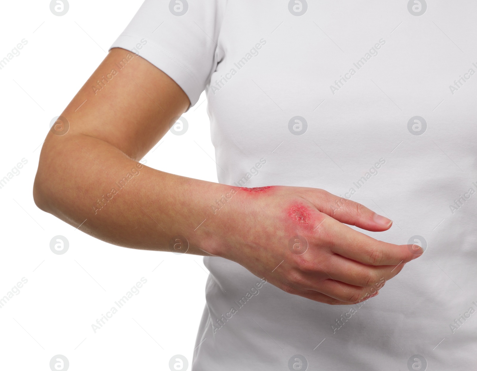 Photo of Woman with burned hand on white background, closeup