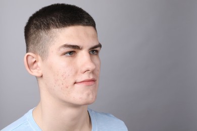 Young man with acne problem on grey background. Space for text