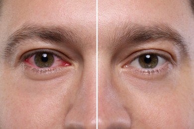 Before and after conjunctivitis treatment. Photos of man with red and healthy eyes, collage