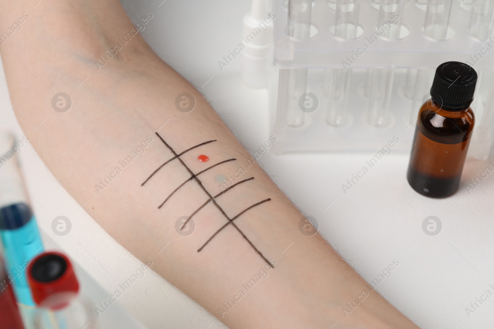 Photo of Patient undergoing skin allergy test at light table in clinic, closeup