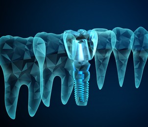 Illustration of  teeth and dental implant on dark blue background