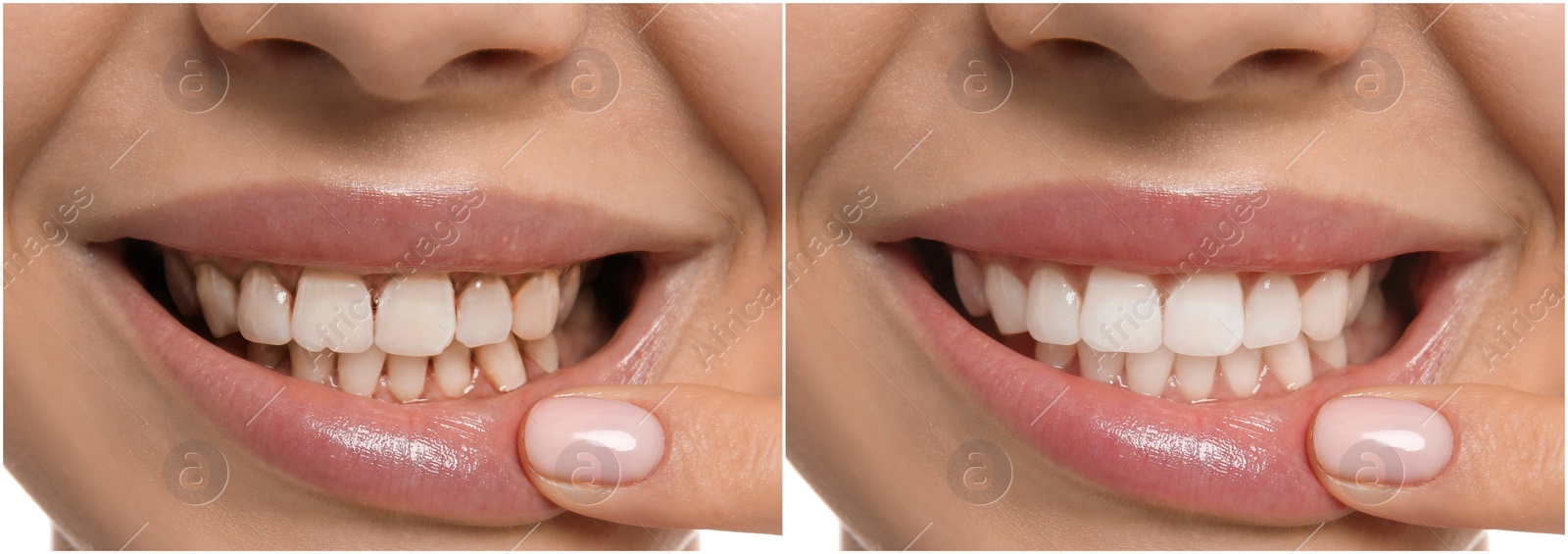 Image of Collage with photos of young woman before and after dental treatment, closeup. Banner design