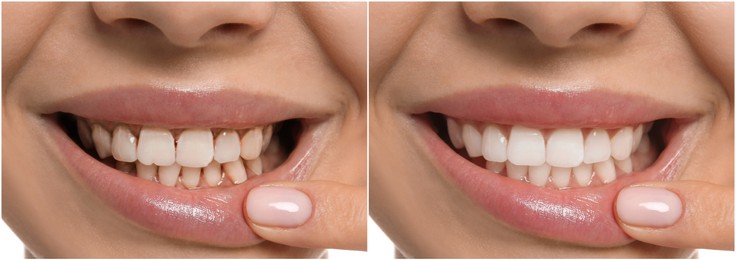 Image of Collage with photos of young woman before and after dental treatment, closeup. Banner design
