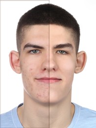 Image of Acne problem, collage. Photo of man divided into halves before and after treatment on white background