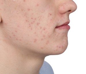 Young man with acne problem isolated on white, closeup