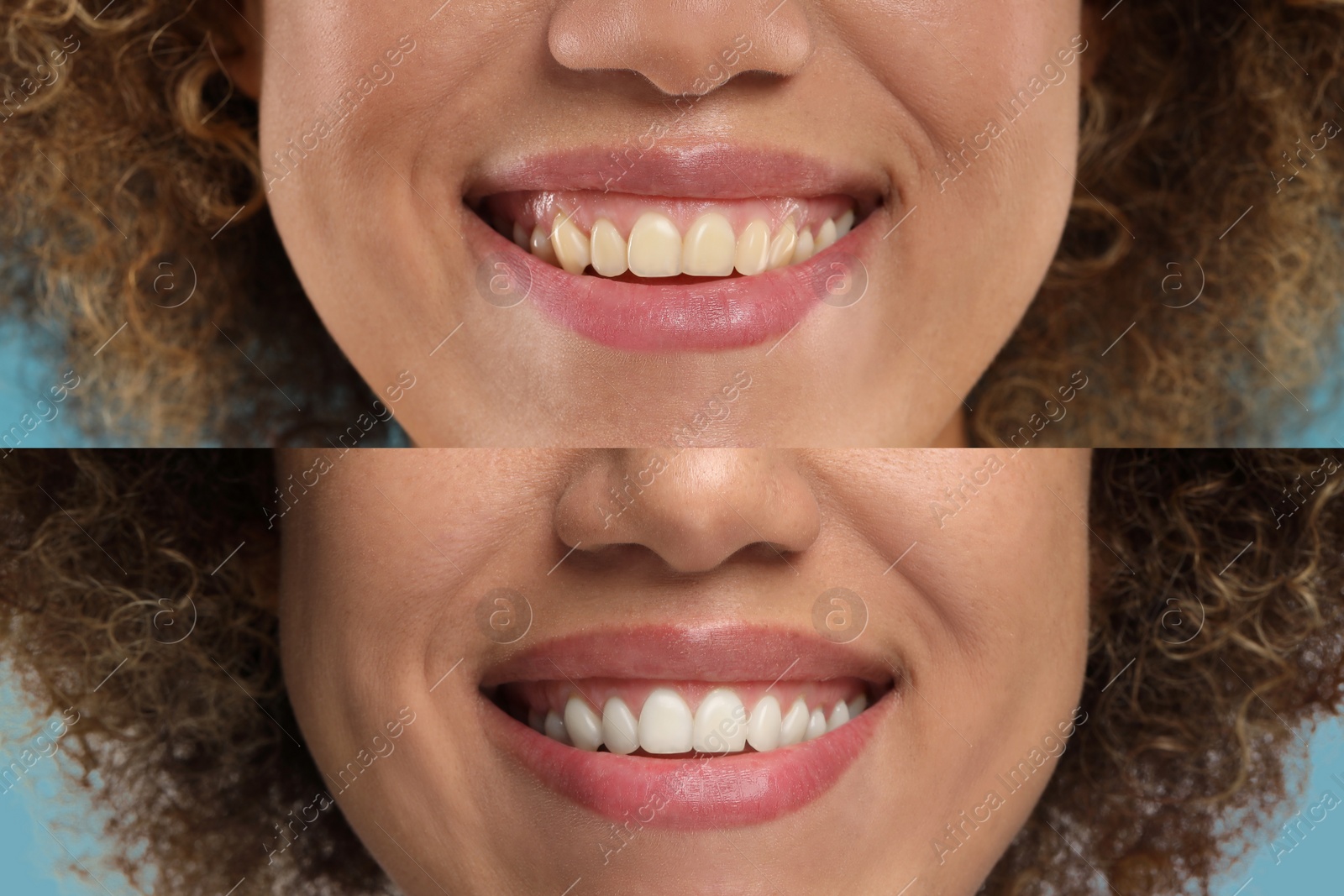 Image of Woman showing teeth before and after whitening, collage