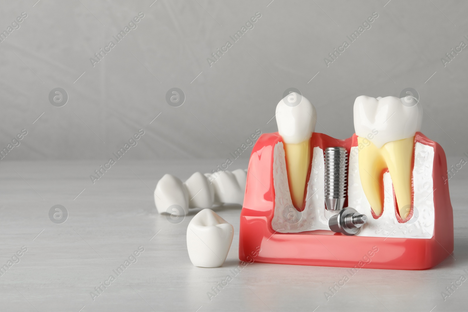 Photo of Educational model of gum with post for dental implant between teeth and crowns on white wooden table