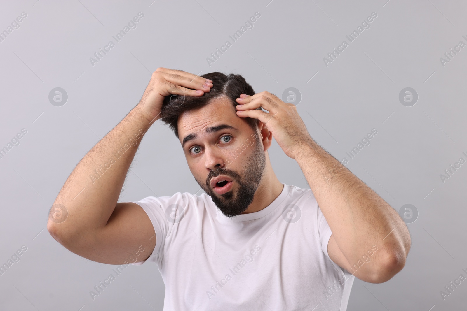 Photo of Emotional man with dandruff in his dark hair on light grey background