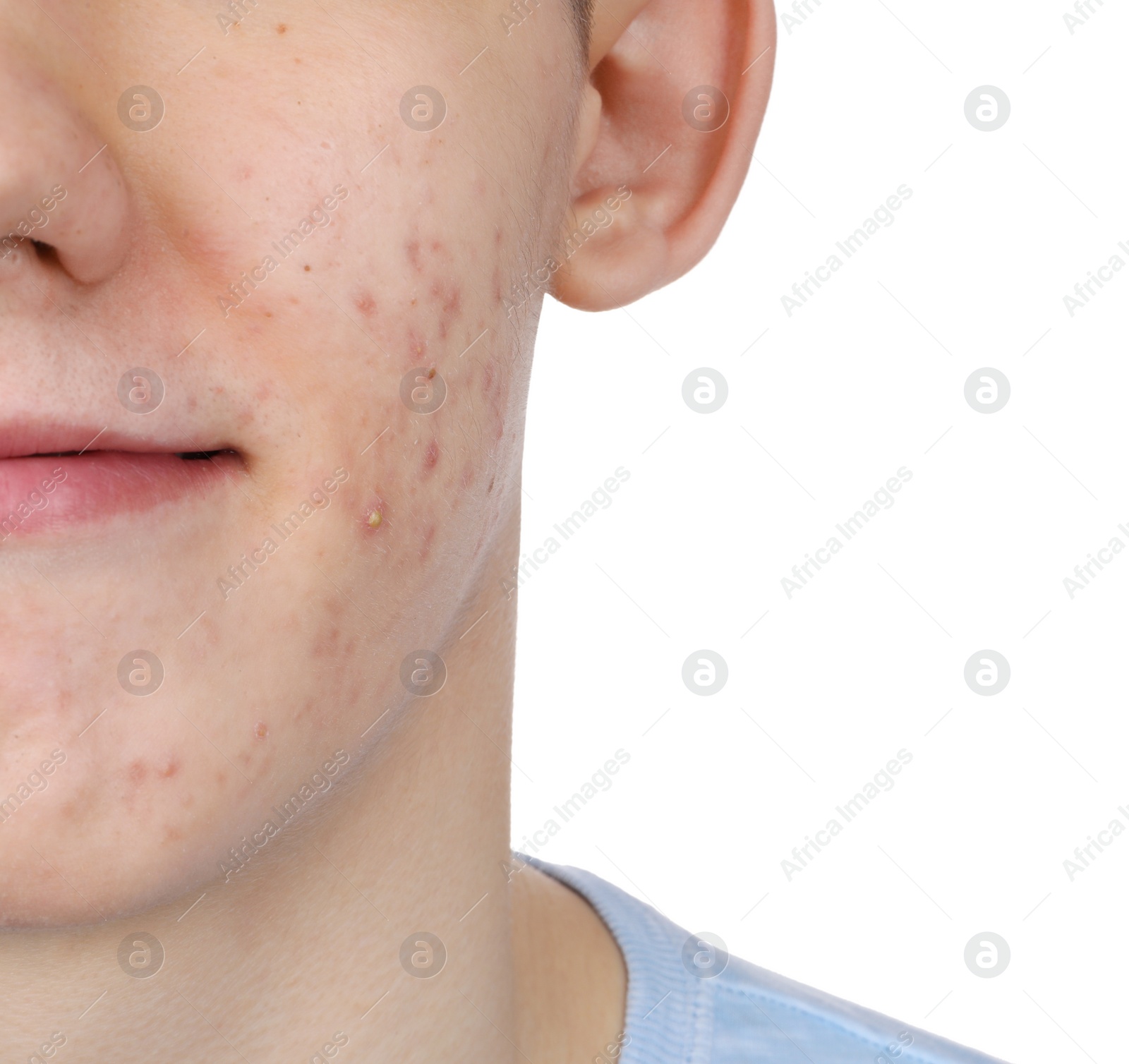 Photo of Young man with acne problem isolated on white, closeup