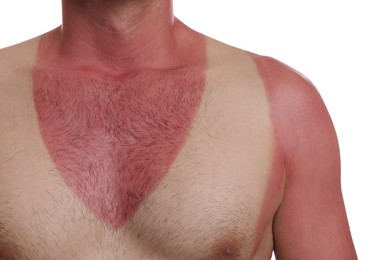 Photo of Man with sunburned skin on white background, closeup