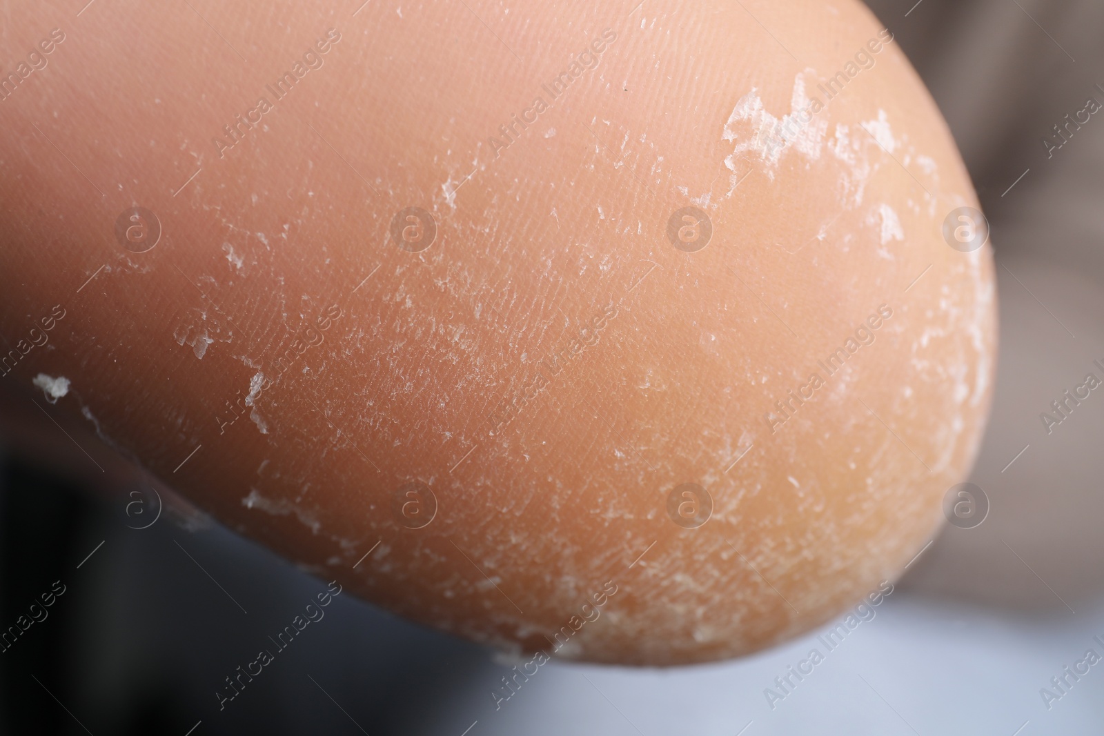 Photo of Woman with dry skin on foot, closeup