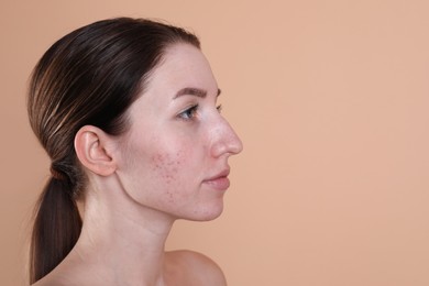 Young woman with acne problem on beige background. Space for text