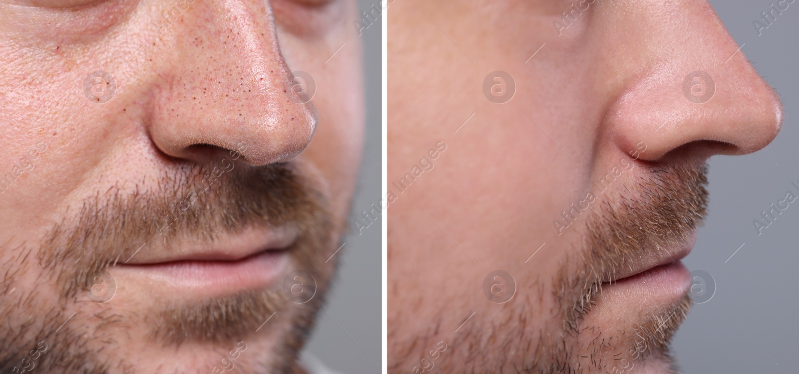 Image of Blackhead treatment, before and after. Collage with photos of man on grey background, closeup view