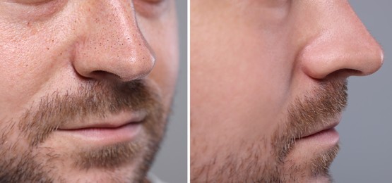 Blackhead treatment, before and after. Collage with photos of man on grey background, closeup view