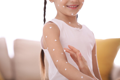 Mother applying cream onto skin of her daughter with chickenpox at home, closeup