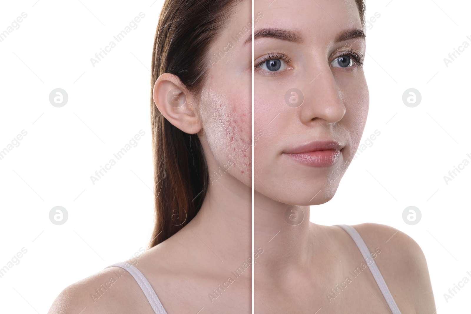 Image of Acne problem, collage. Photo of woman divided into halves before and after treatment on white background