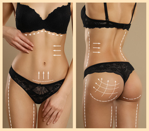 Image of Photos of young woman with marks on body against beige background, closeup. Cosmetic surgery concept