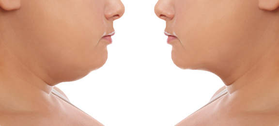 Woman before and after plastic surgery operation on white background, closeup. Double chin problem