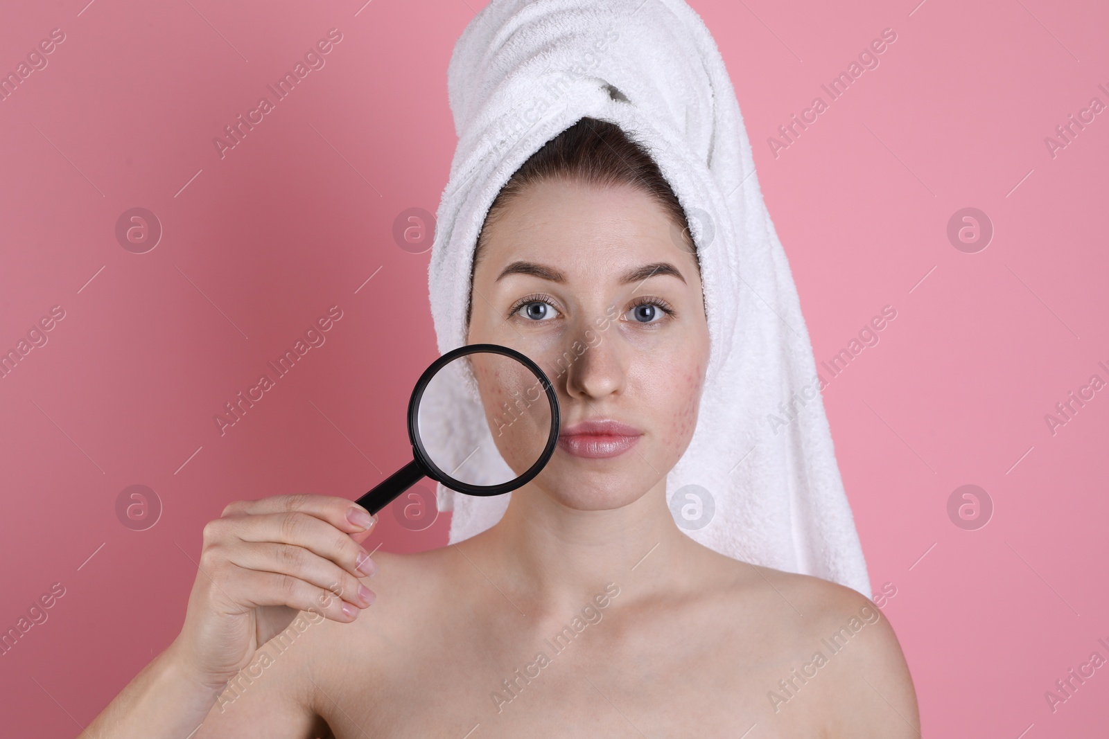 Photo of Young woman with acne problem holding magnifying glass near her skin on pink background