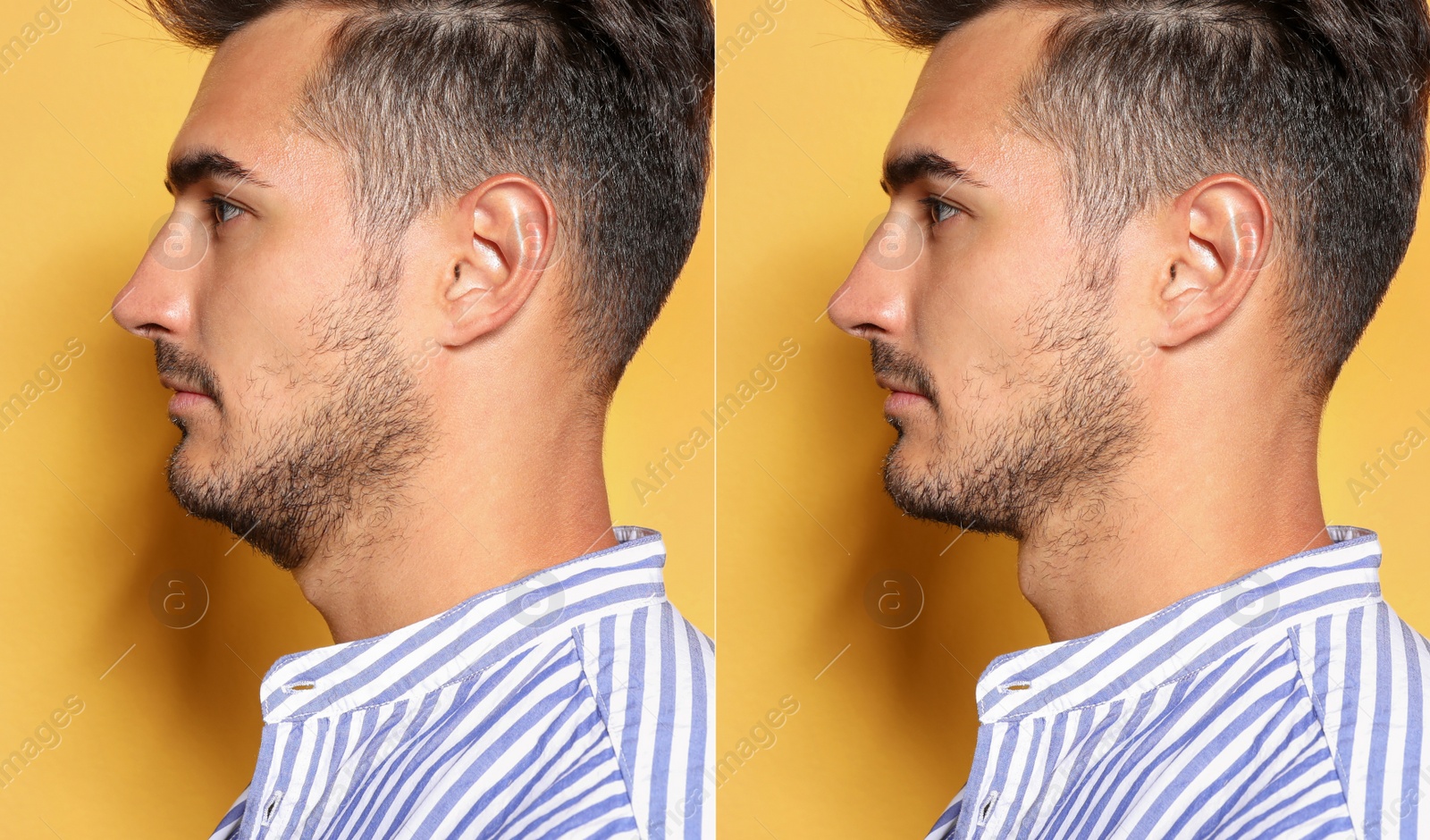 Image of Double chin problem. Collage with photos of man before and after plastic surgery procedure on yellow background