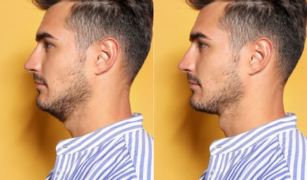 Image of Double chin problem. Collage with photos of man before and after plastic surgery procedure on yellow background