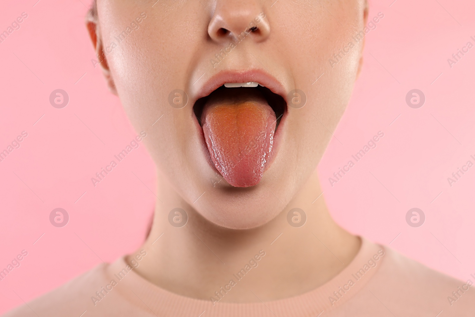 Photo of Gastrointestinal diseases. Woman showing her yellow tongue on pink background, closeup