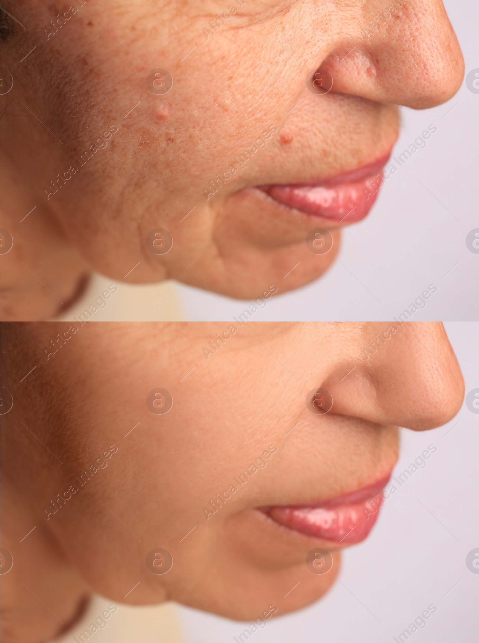 Image of Woman before and after rejuvenating procedures. Collage with photos on white background, closeup