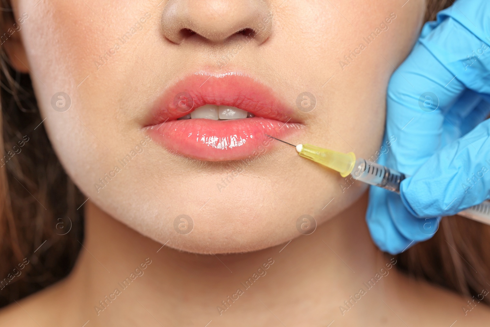 Photo of Young woman getting lips injection, closeup. Cosmetic surgery