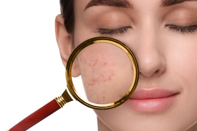 Image of Dermatology. Woman with skin problem on white background, closeup. View through magnifying glass on acne