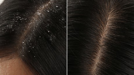 Woman showing hair before and after dandruff treatment, collage