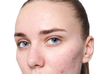 Young woman with acne problem on white background