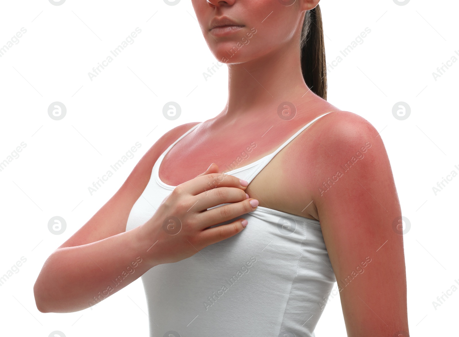 Photo of Woman with sunburned skin on white background, closeup