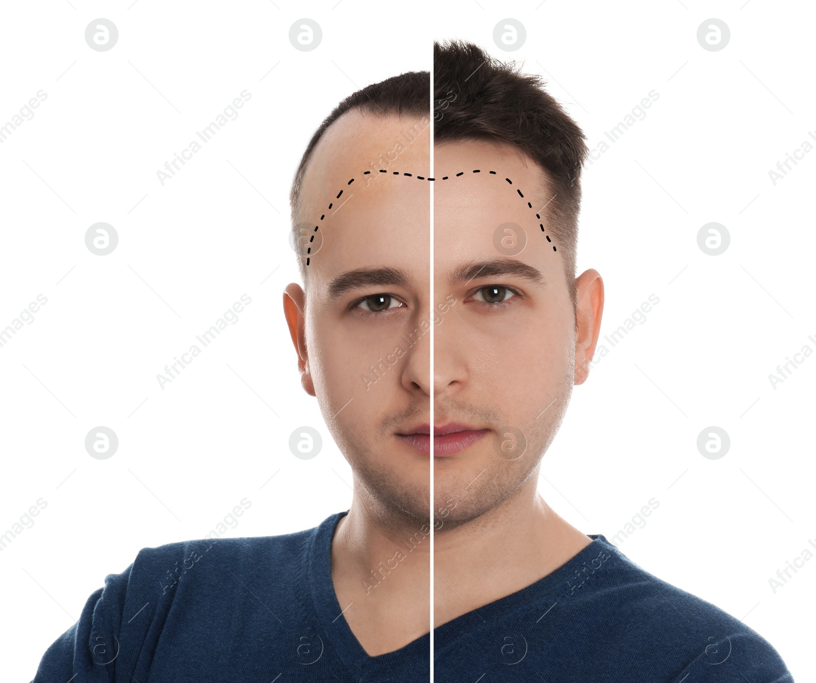 Image of Man before and after hair loss treatment on white background, collage