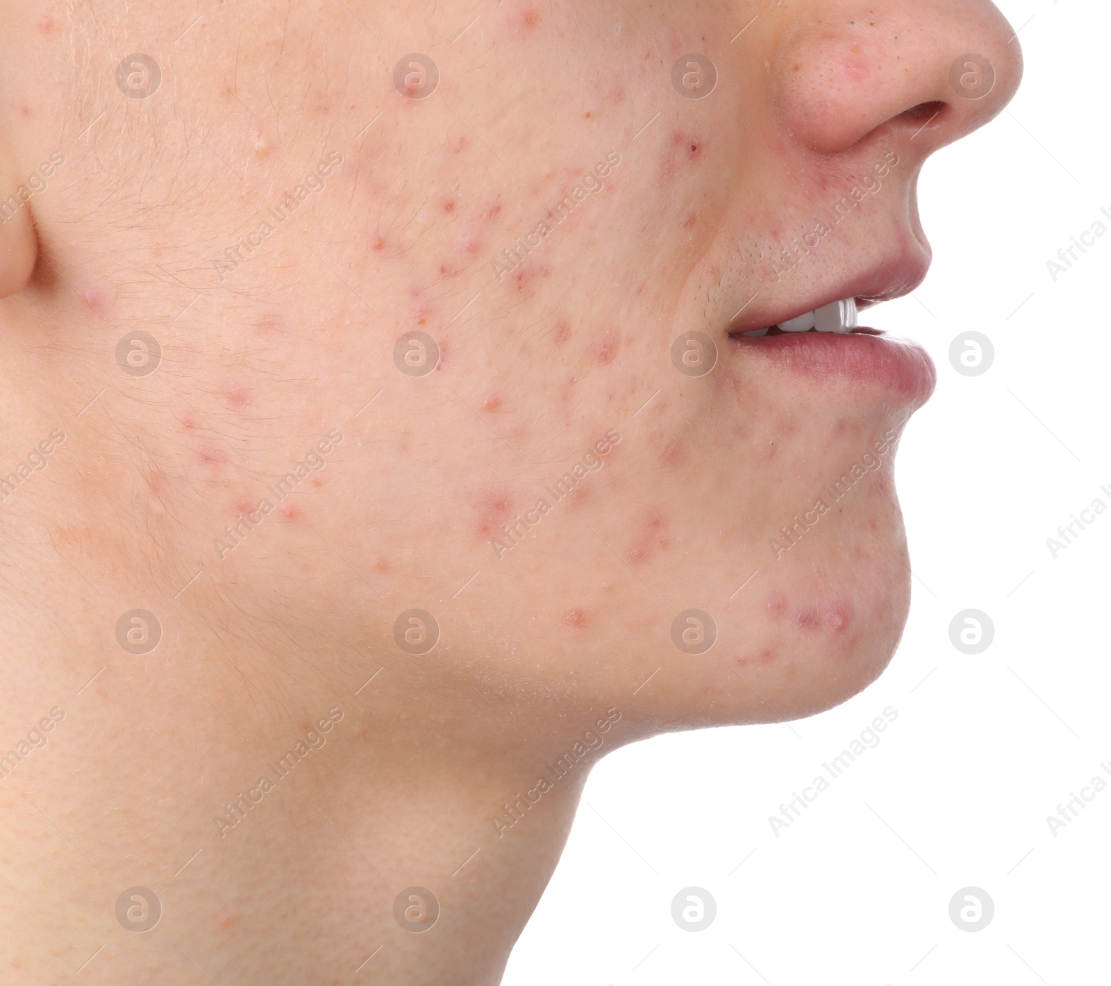 Photo of Young man with acne problem isolated on white, closeup