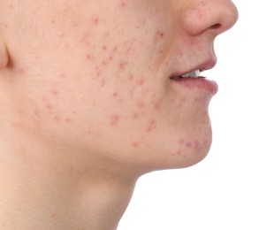 Photo of Young man with acne problem isolated on white, closeup