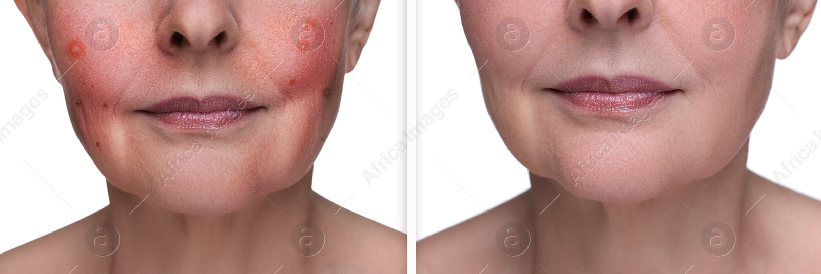 Image of Before and after rosacea treatment. Photos of woman on white background, closeup. Collage showing affected and healthy skin