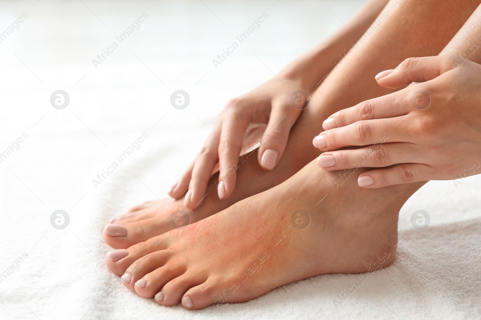 Image of Closeup view of woman with dry skin on feet