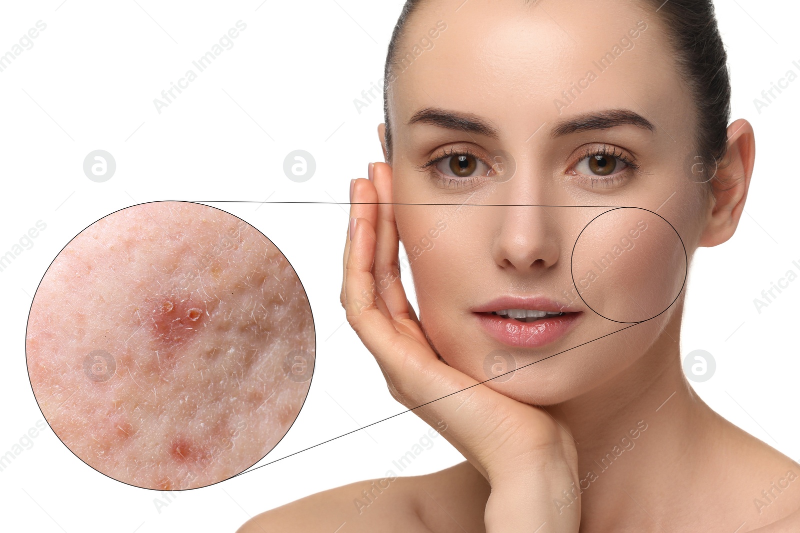 Image of Dermatology. Woman with skin problem on white background. Zoomed area showing acne