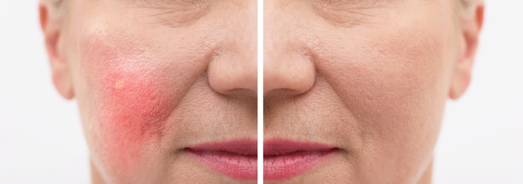 Before and after rosacea treatment. Photos of woman on white background, closeup. Collage showing affected and healthy skin