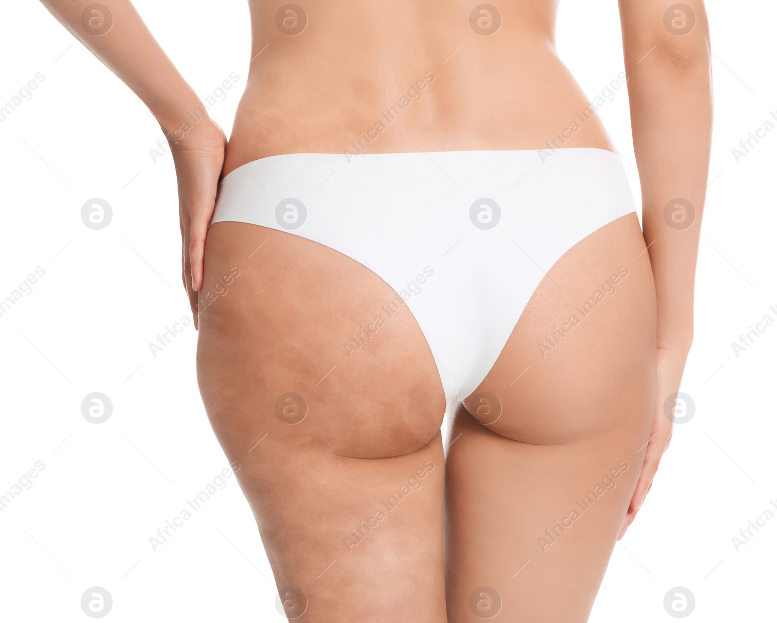 Image of Young woman in underwear before and after beauty procedure on white background, closeup. Body care