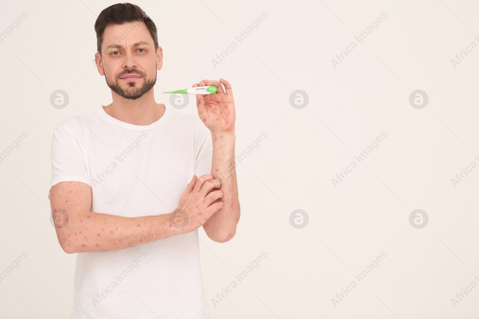 Photo of Man with rash holding thermometer on beige background, space for text. Monkeypox virus diagnosis