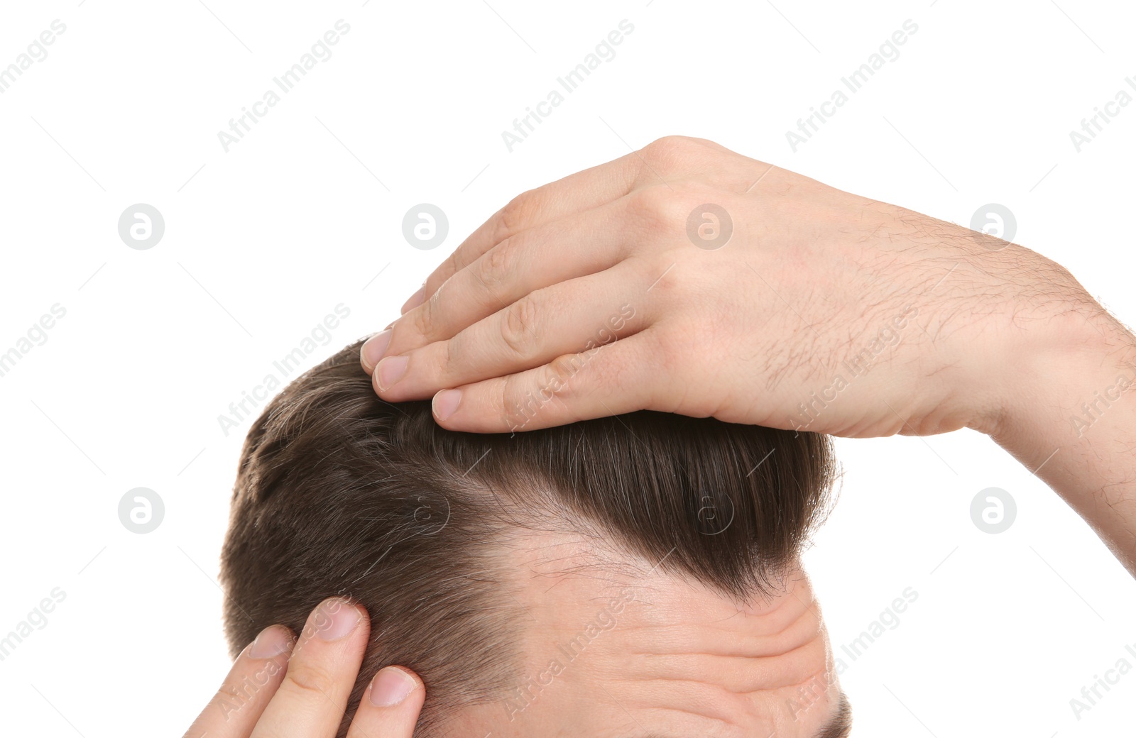 Photo of Young man with hair loss problem on white background