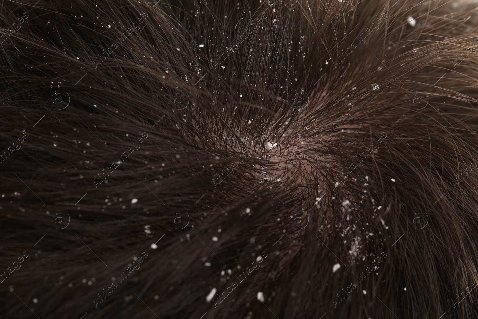 Photo of Man with dandruff in his dark hair, closeup