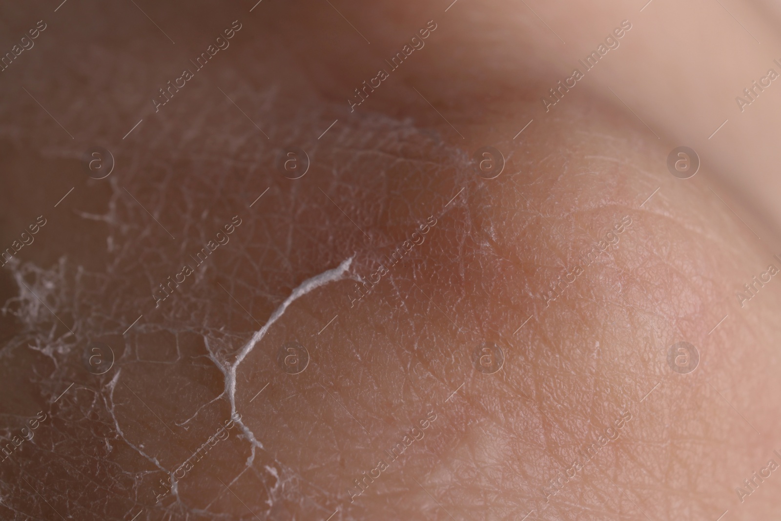 Photo of Woman with dry skin on hand, macro view