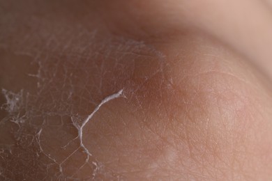 Photo of Woman with dry skin on hand, macro view