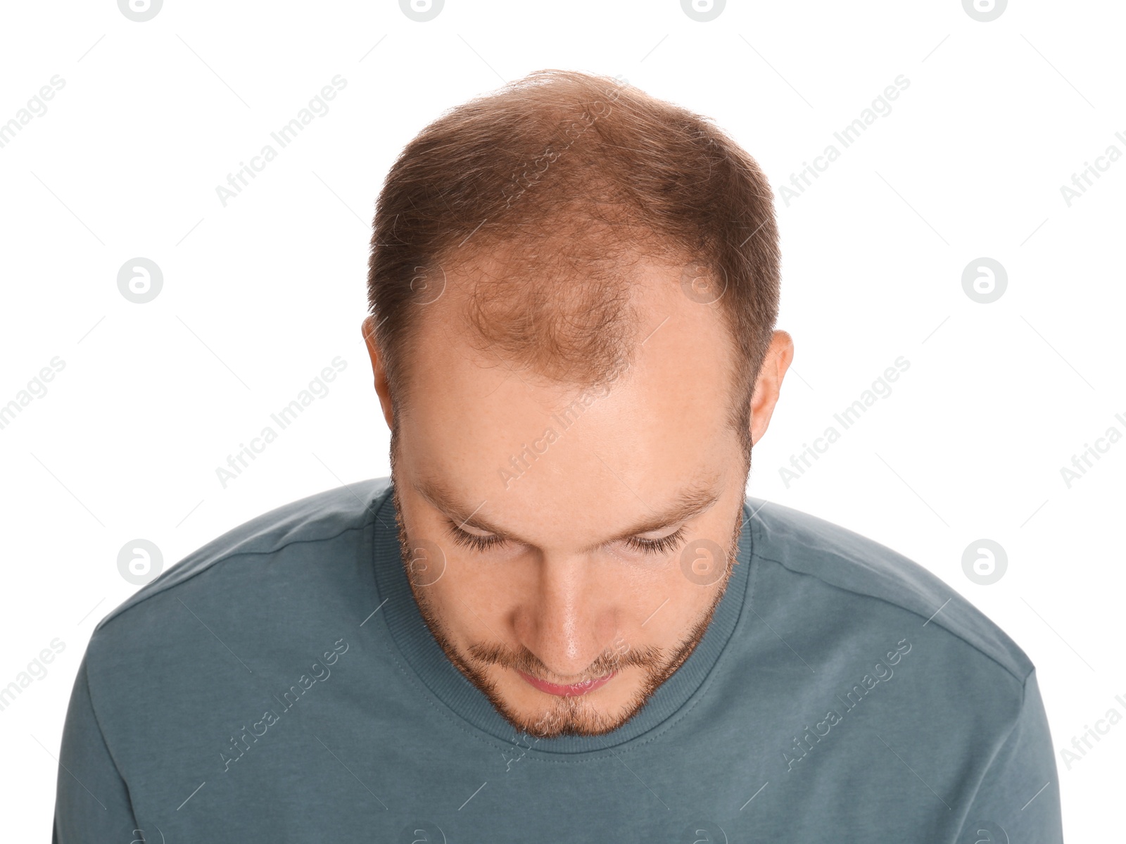 Photo of Man with hair loss problem isolated on white, above view. Trichology treatment